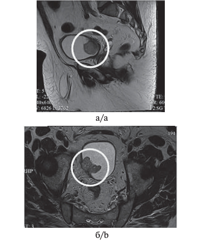 МР-изображение органов малого таза