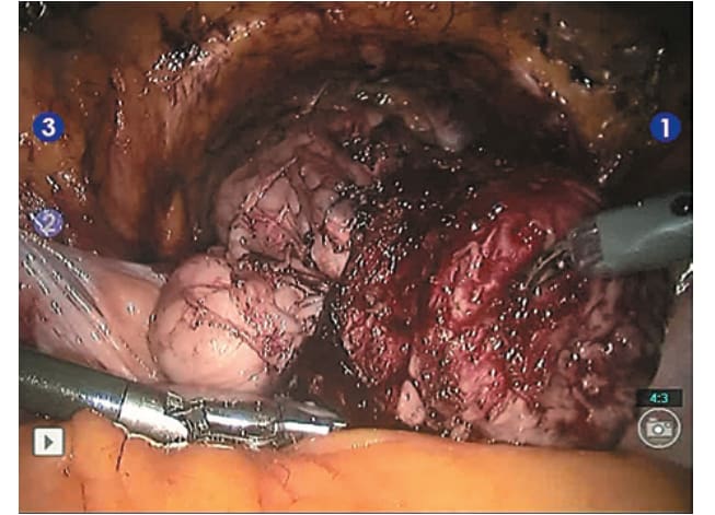 Апикальная часть простаты выделена, отсечена от дорзального венозного комплекса с перевязкой последнего; отсечена от уретры и помещена в лапароскопический эвакуатор