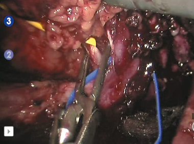 Наложен сосудистый зажим по типу «бульдог» на правую почечную артерию