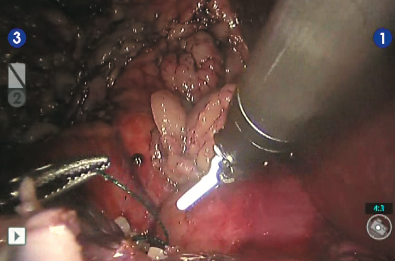 Снятие зажима с почечной артерии и оценка гемостаза ушитого ложа опухоли