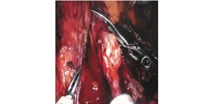 Рис. 5. Артериотомия левой общей подвздошной артерии (интраоперационая эндофотография). Fig. 5. Arteriotomy of the left common iliac artery.