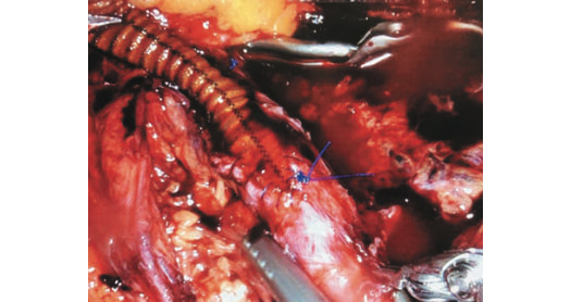 Рис. 7. Сформированный проксимальный анастамоз меж- ду общей подвздошной артерией и протезом JOTEC 8 мм (интраоперационая эндофотография). Fig. 7. Proximal anastomosis between common iliac artery and JOTEC 8 mm prosthesis.