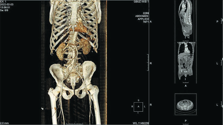 Рис. 9. 3D-реконструкция МСКТ с внутривенным контрастированием после оперативного вмешательства (интраопе- рационая эндофотография). Fig. 9. Postoperative 3D CT angiography.