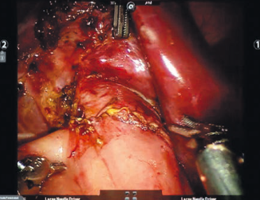 Рис. 4. Интраоперационная фотография гепатикоеюноа- настомоза по типу конец в бок. Fig. 4. Intraoperative image of end-to-side hepaticojejunostomy.