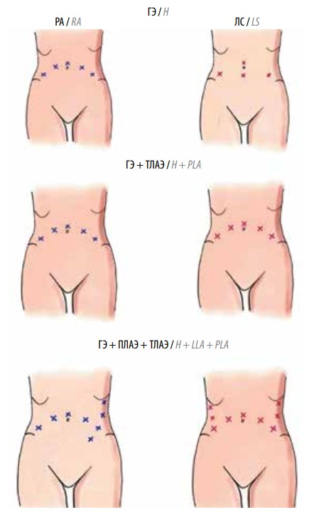 Схемы расположения троакаров при
                робот-ассистированных (РА) и лапароскопических (ЛС) операциях