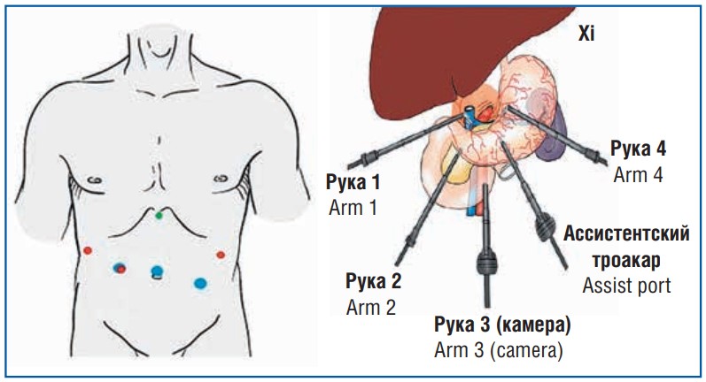 Схема расстановки троакаров комплекса da Vinci Xi