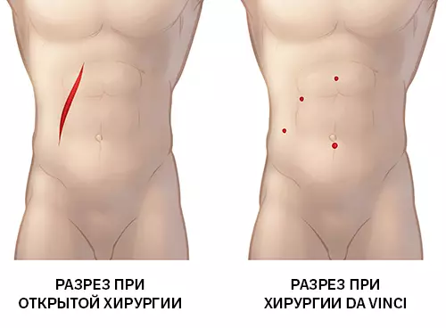 разрезы при робот-ассистированной резекции желчного пузыря