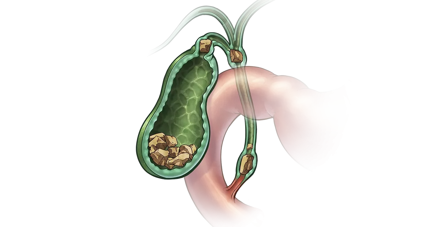 Желчекаменная болезнь: симптомы, причины, лечение