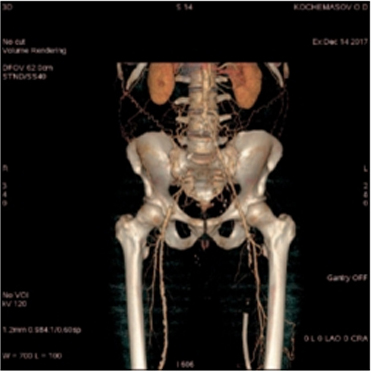 КТ-ангиография брюшной аорты и подвздошных артерий пациента К