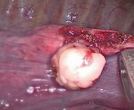 Эндофотограмма вылущенной гамартохондромы