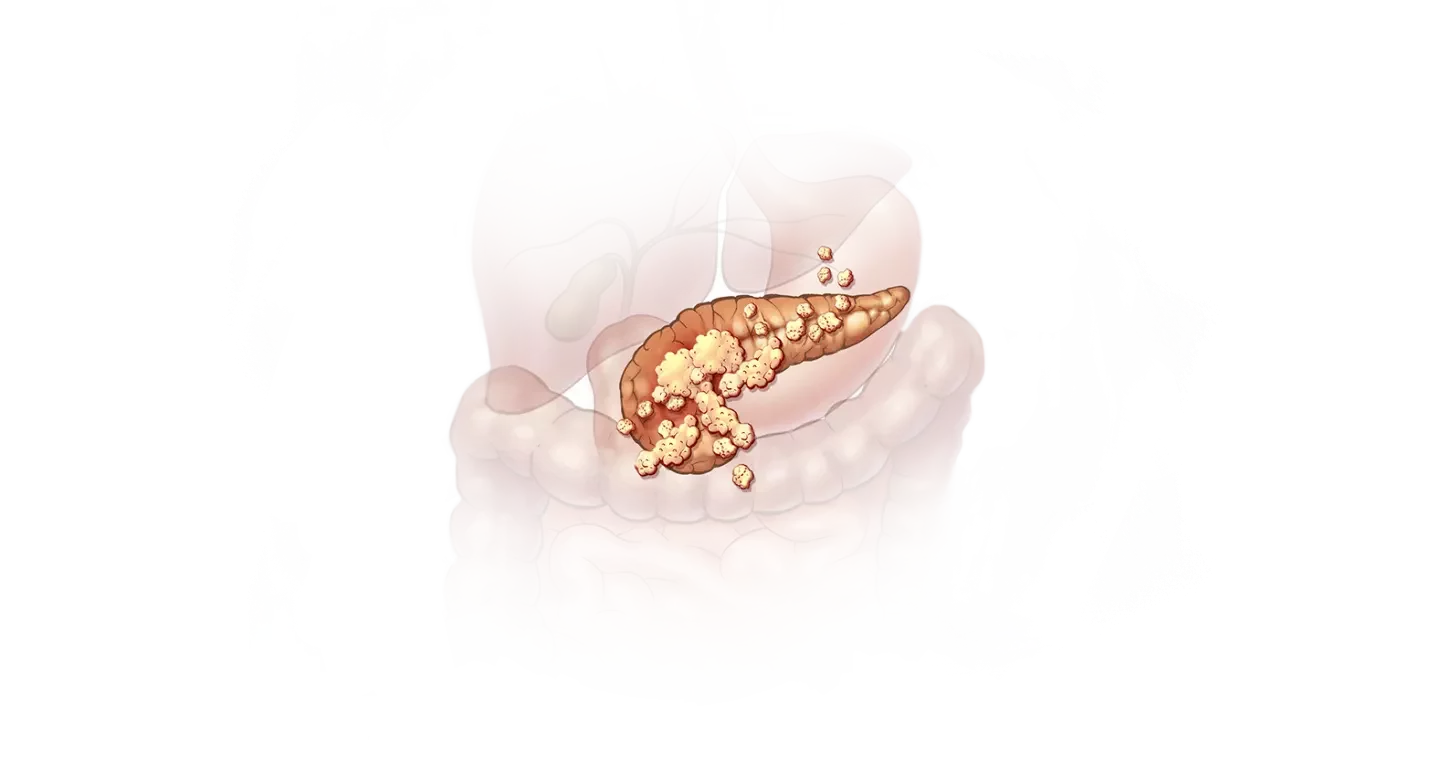 Рак поджелудочной железы: симптомы, проявление, лечение