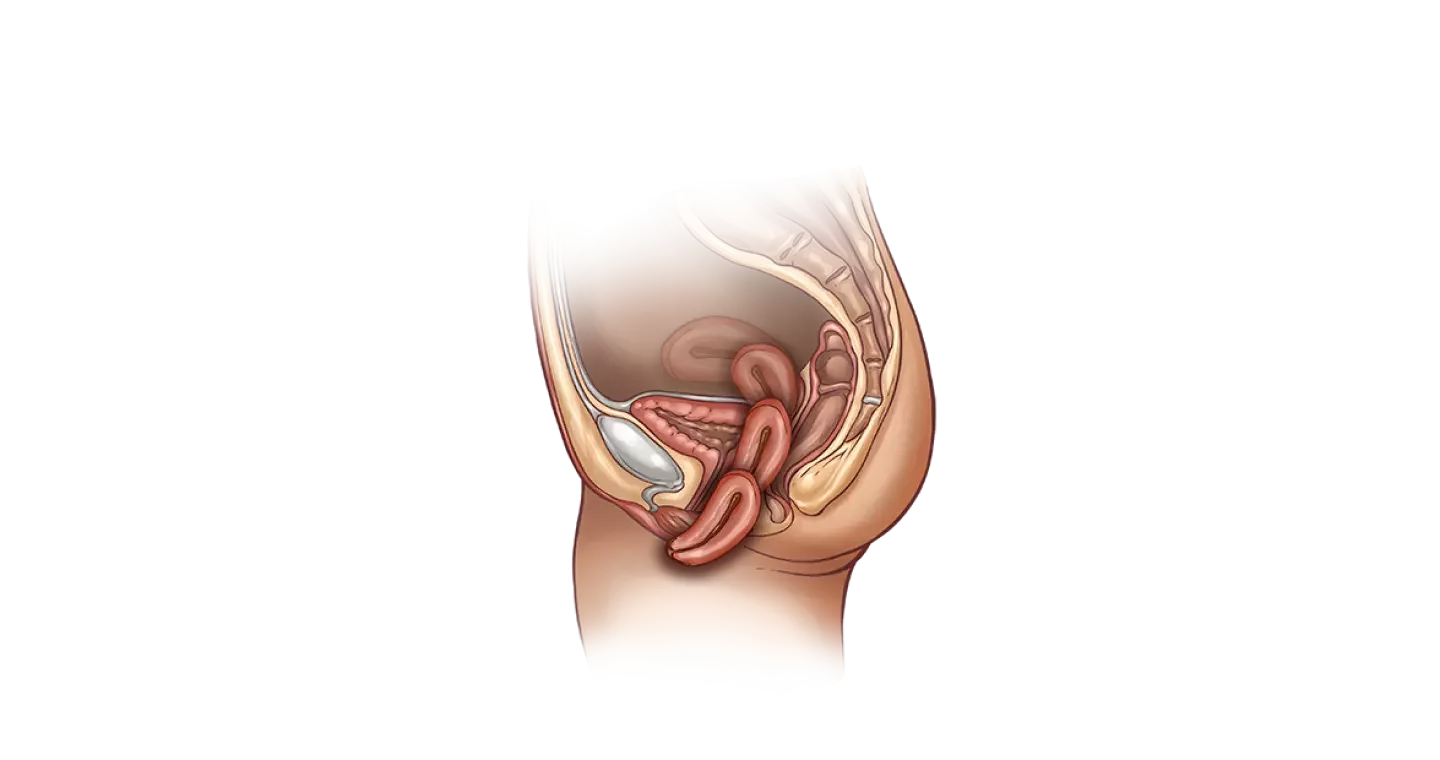 Опущение матки: симптомы, диагностика, лечение