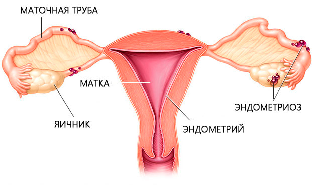 Эндометриоз яичника