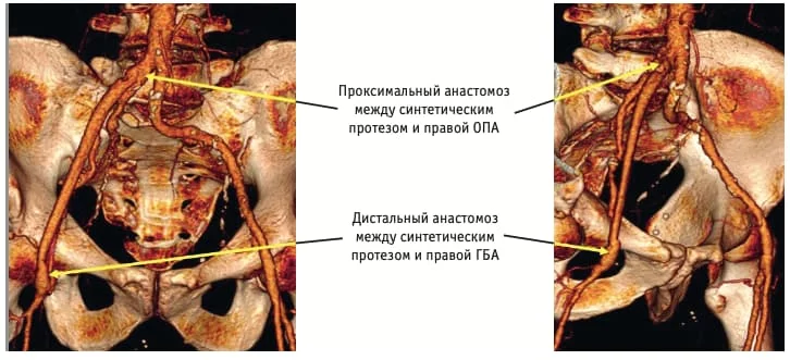 Рис. 3. Результаты мультиспиральной компьютерной томографии-ангиографии с 3D-реконструкцией инфраренального отдела аорты и артерий нижних конечностей после операции