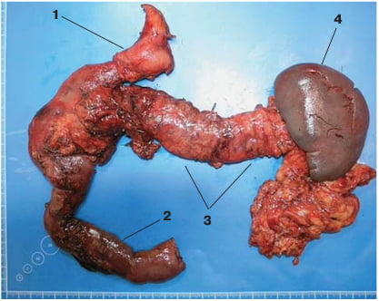 Удаленный комплекс органов. 1 – культя желудка, 2 – тощая кишка, 3 – ПЖ, 4 – селезенка с селезеночно-ободочной связкой.