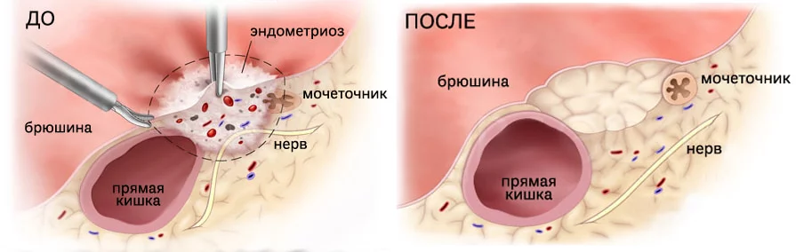 Минимально инвазивная хирургия при эндометриозе