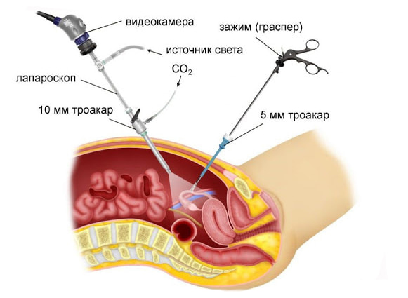 Диагностика и удаление очагов эндометриоза лапароскопическим методом