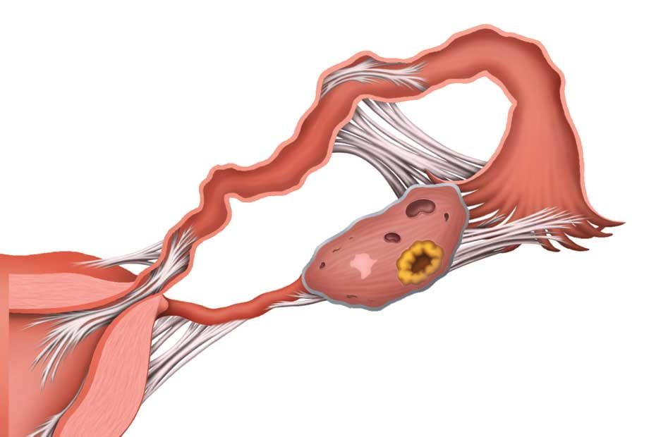 Непроходимость маточных труб из-за спаек при эндометриозе
