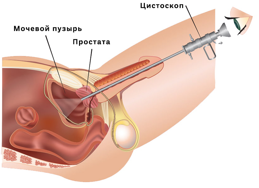 Цистоскопия у мужчины