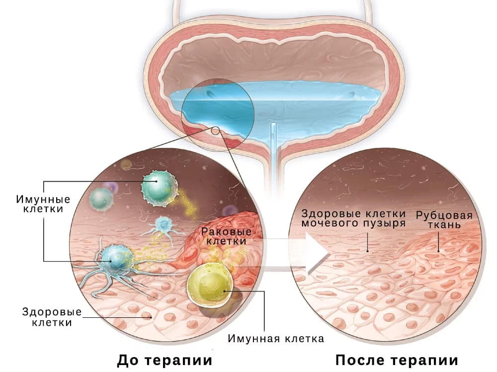 Интравезикулярная (внутрипузырная) терапия