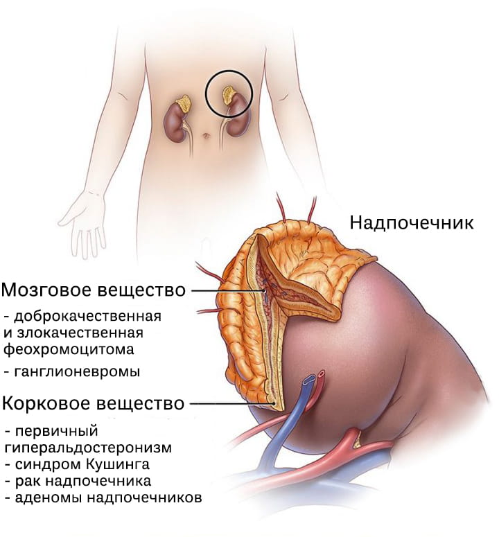 Классификация опухолей надпочечника