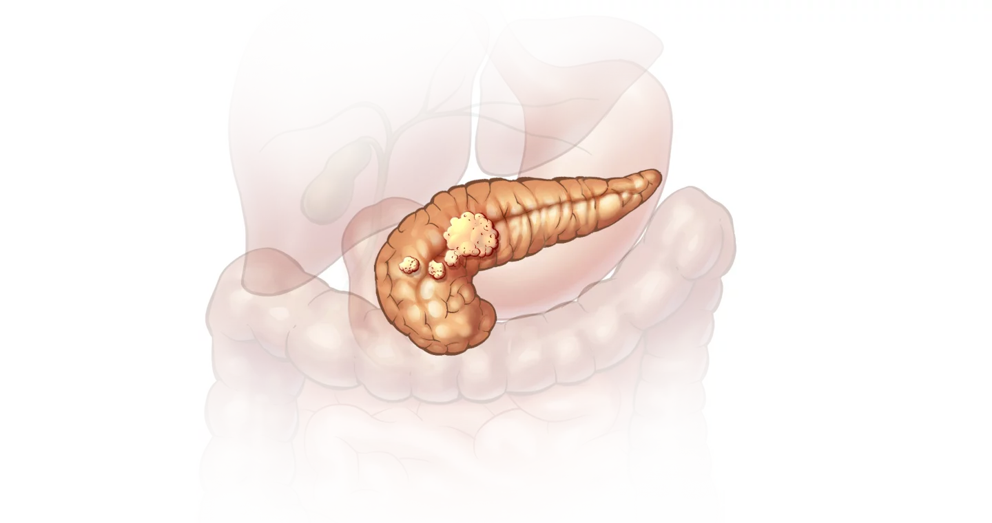 Поджелудочную без. Поджелудочная железа pancreas. Инсулинома поджелудочной железы. Поджелудочная железа без фона. Поджелудочная железа гиф.