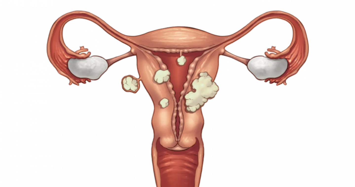 Миома матки: симптомы и признаки, лечение