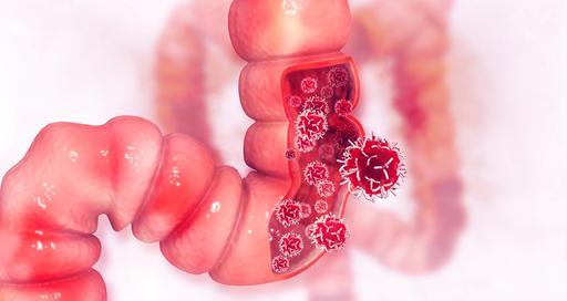 Intuitive Colon Channel