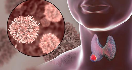 Рак щитовидной железы - симптомы, признаки.
