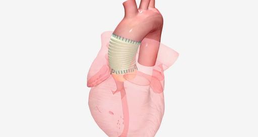 Восстановление митрального клапана