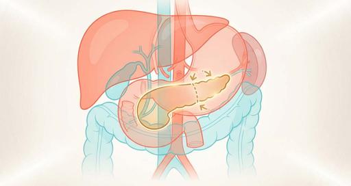 Полная резекция поджелудочной железы