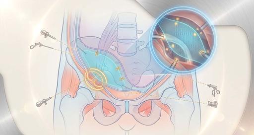 ТАРР герниопластика