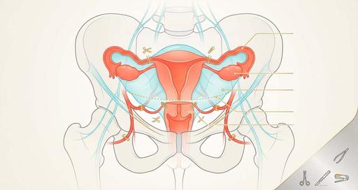 Удаление матки